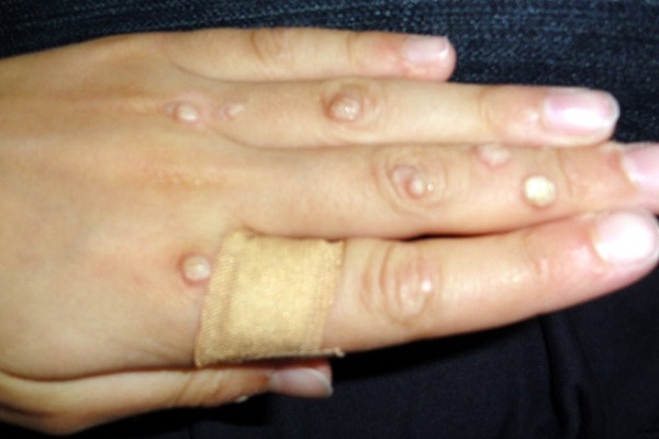 warts removal