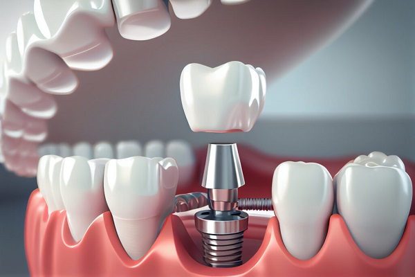 Dental Implant Ghaziabad