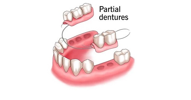 partial dentures