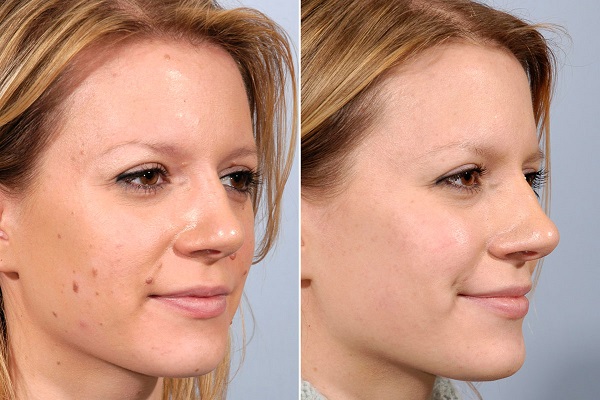 mole removal in ghaziabad